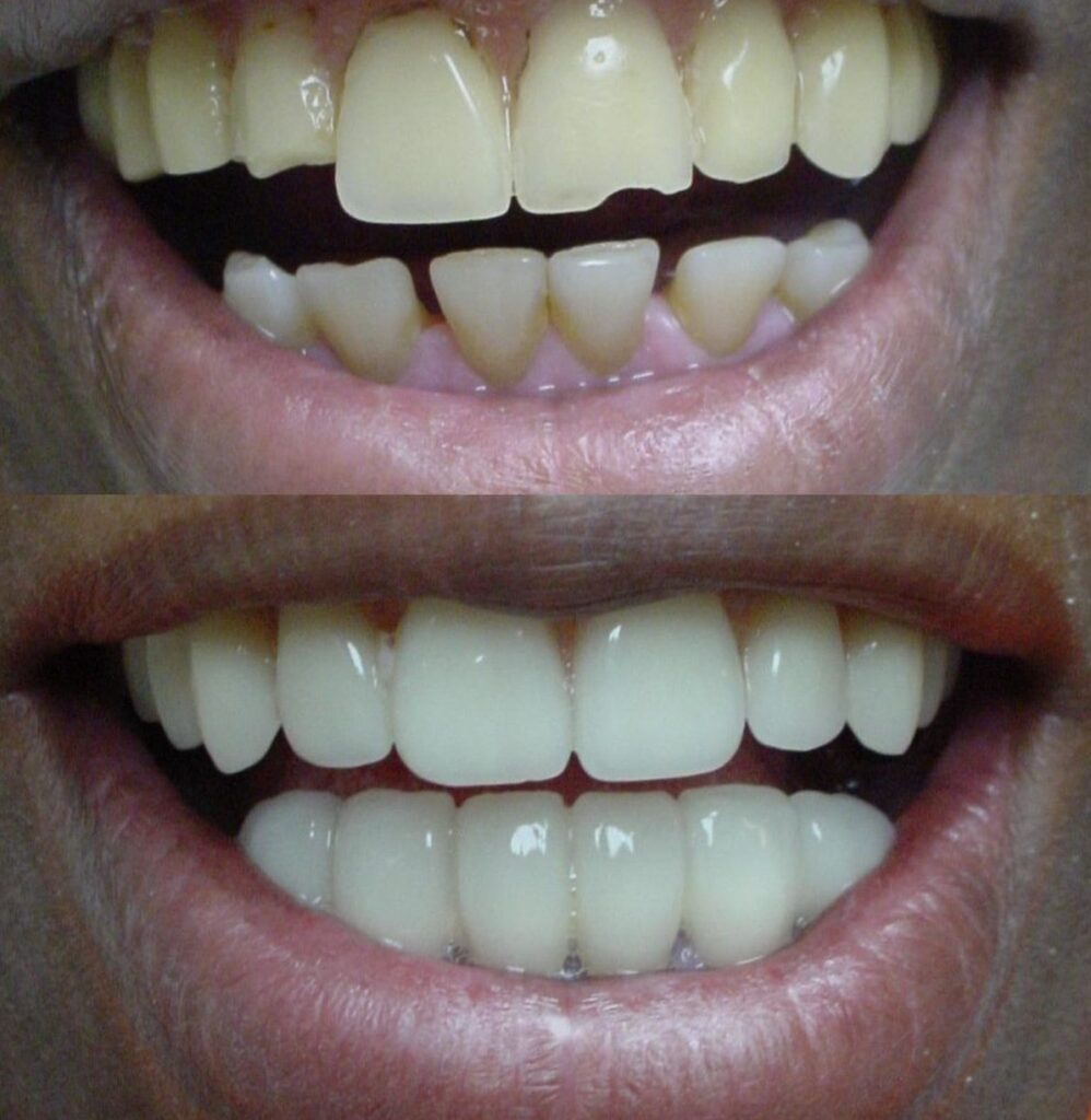 Patient before and after Crowns treatment at Dental Care 4 U